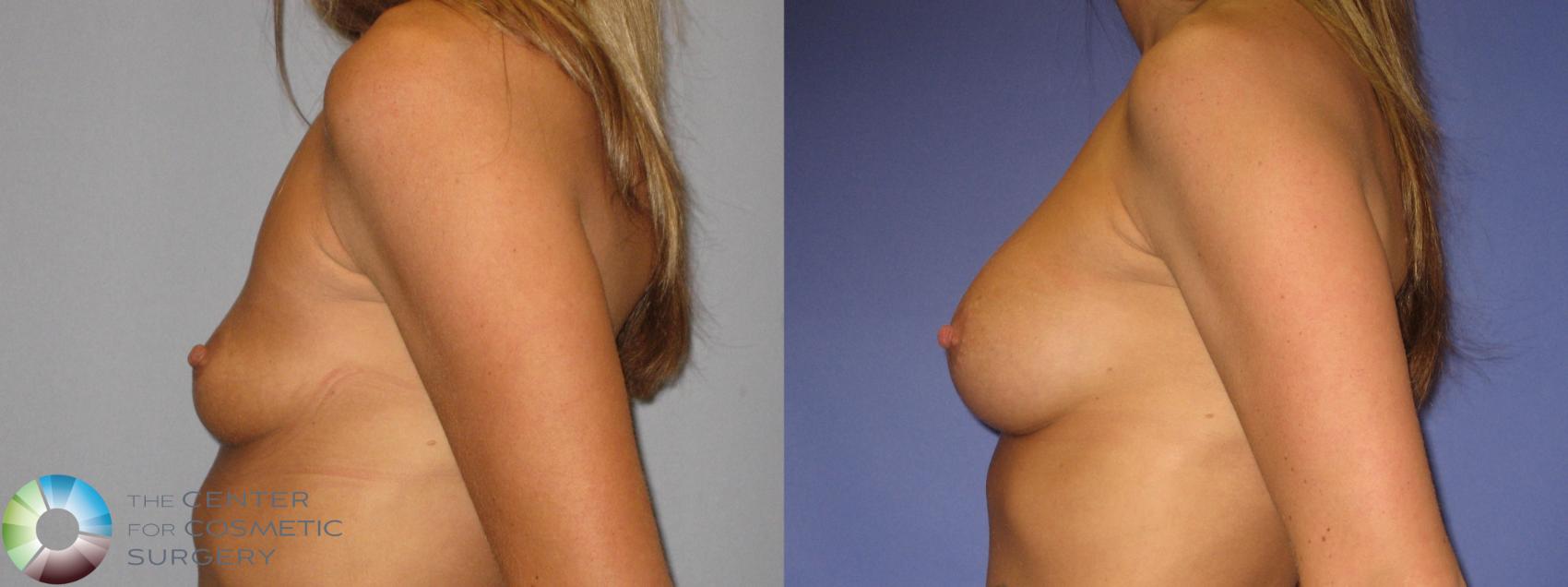 Before & After Breast Augmentation Case 274 View #3 in Denver and Colorado Springs, CO