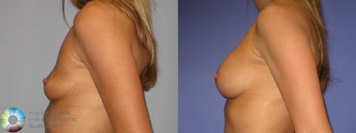 Before & After Breast Augmentation Case 274 View #3 View in Golden, CO