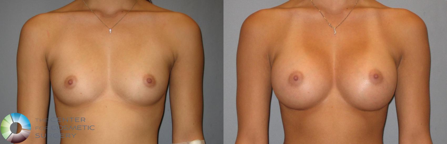 Before & After Breast Augmentation Case 275 View #1 in Denver and Colorado Springs, CO