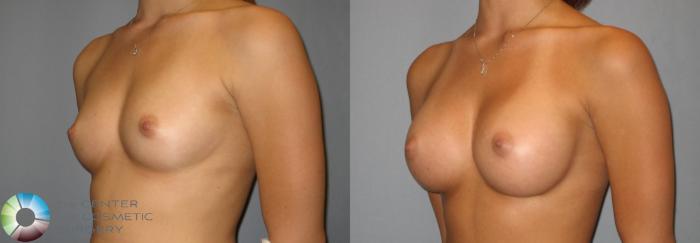 Before & After Breast Augmentation Case 275 View #2 View in Golden, CO