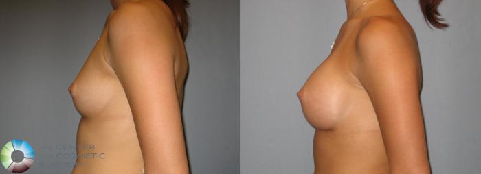 Before & After Breast Augmentation Case 275 View #3 View in Golden, CO