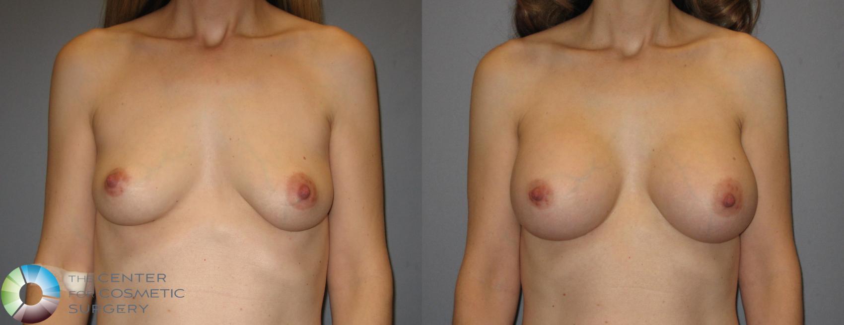 Before & After Breast Augmentation Case 284 View #1 in Denver, CO