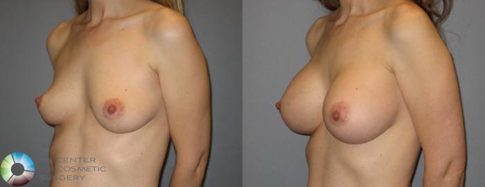 Before & After Breast Augmentation Case 284 View #2 View in Golden, CO