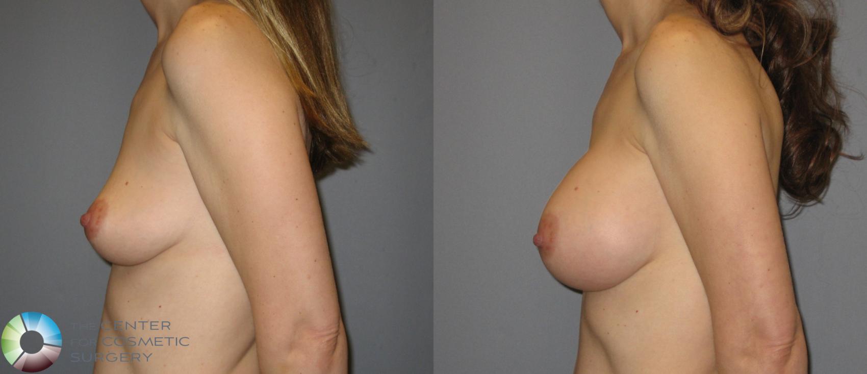 Before & After Breast Augmentation Case 284 View #3 in Denver and Colorado Springs, CO