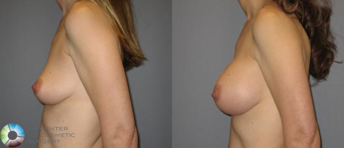 Before & After Breast Augmentation Case 284 View #3 View in Golden, CO