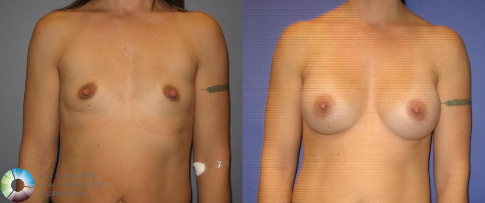 Before & After Breast Augmentation Case 285 View #1 in Denver and Colorado Springs, CO