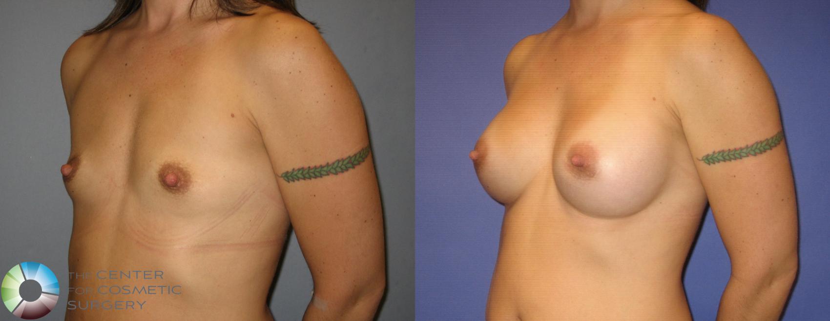 Before & After Breast Augmentation Case 285 View #2 View in Golden, CO