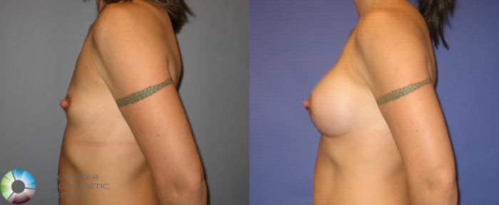 Before & After Breast Augmentation Case 285 View #3 View in Golden, CO