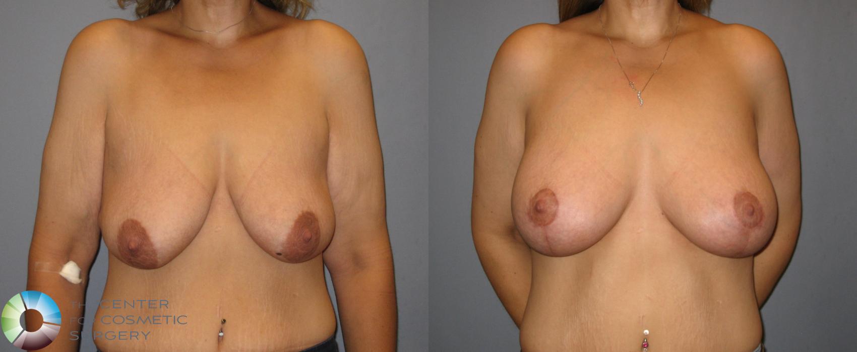 Before & After Breast Augmentation Case 286 View #1 in Denver and Colorado Springs, CO