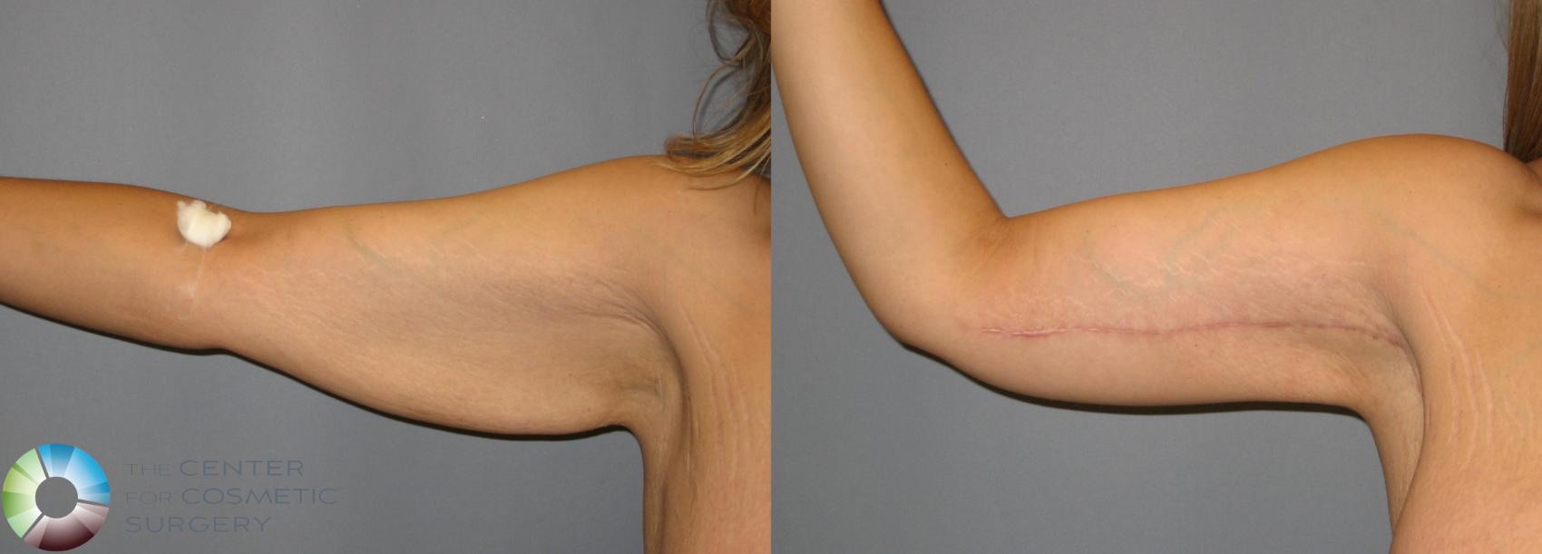 Before & After Breast Augmentation Case 286 View #2 in Denver and Colorado Springs, CO