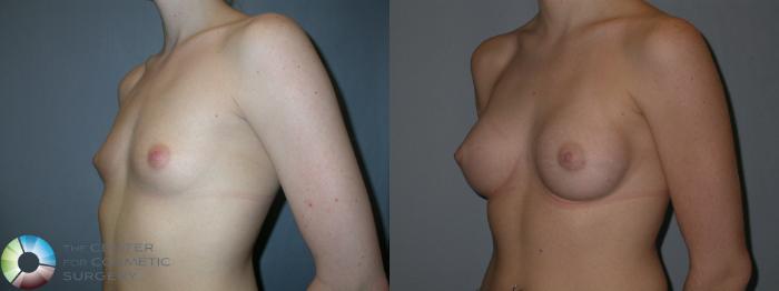 Before & After Breast Augmentation Case 29 View #1 in Denver and Colorado Springs, CO