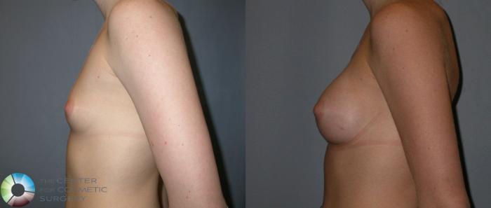 Before & After Breast Augmentation Case 29 View #2 in Denver and Colorado Springs, CO
