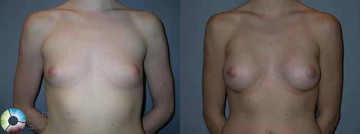 Before & After Breast Augmentation Case 29 View #3 in Denver and Colorado Springs, CO