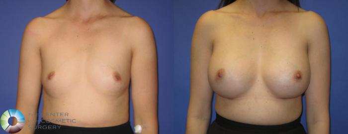 Before & After Breast Augmentation Case 290 View #1 in Denver and Colorado Springs, CO