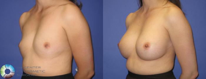 Before & After Breast Augmentation Case 290 View #2 in Denver and Colorado Springs, CO