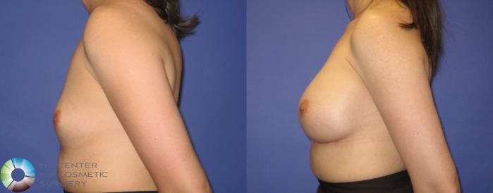 Before & After Breast Augmentation Case 290 View #3 in Denver and Colorado Springs, CO