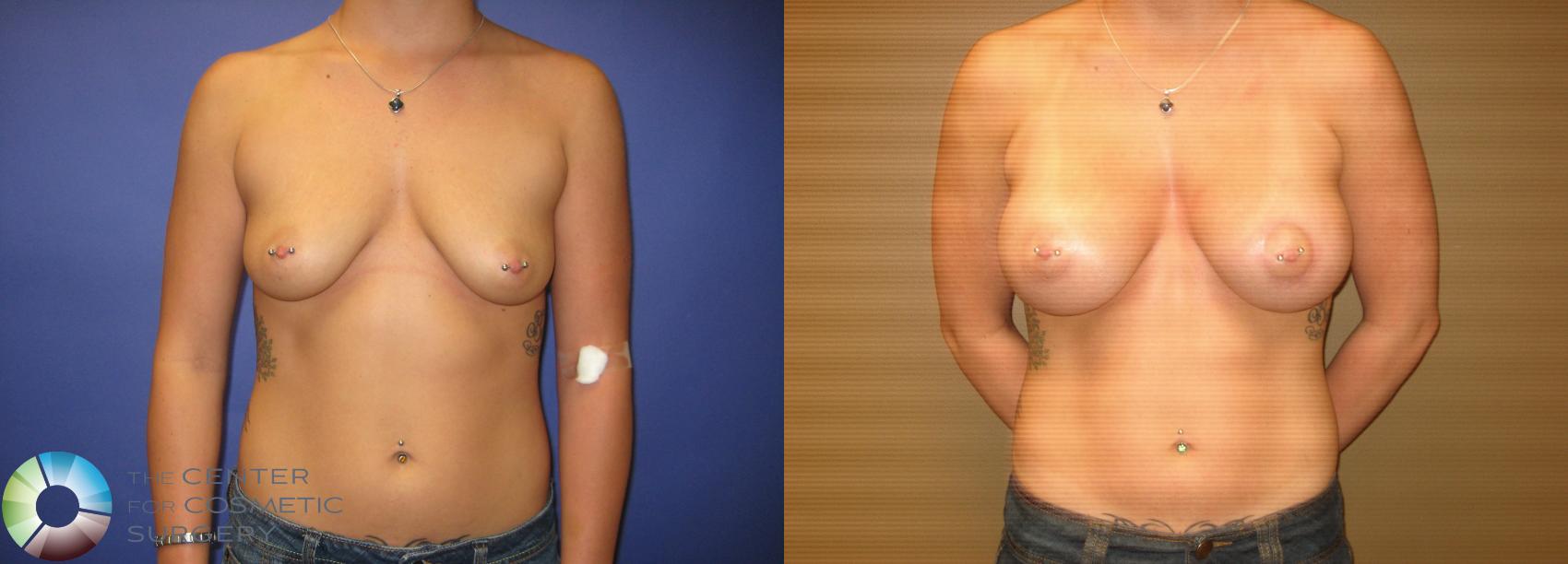 Before & After Breast Augmentation Case 294 View #1 View in Denver & Golden, CO