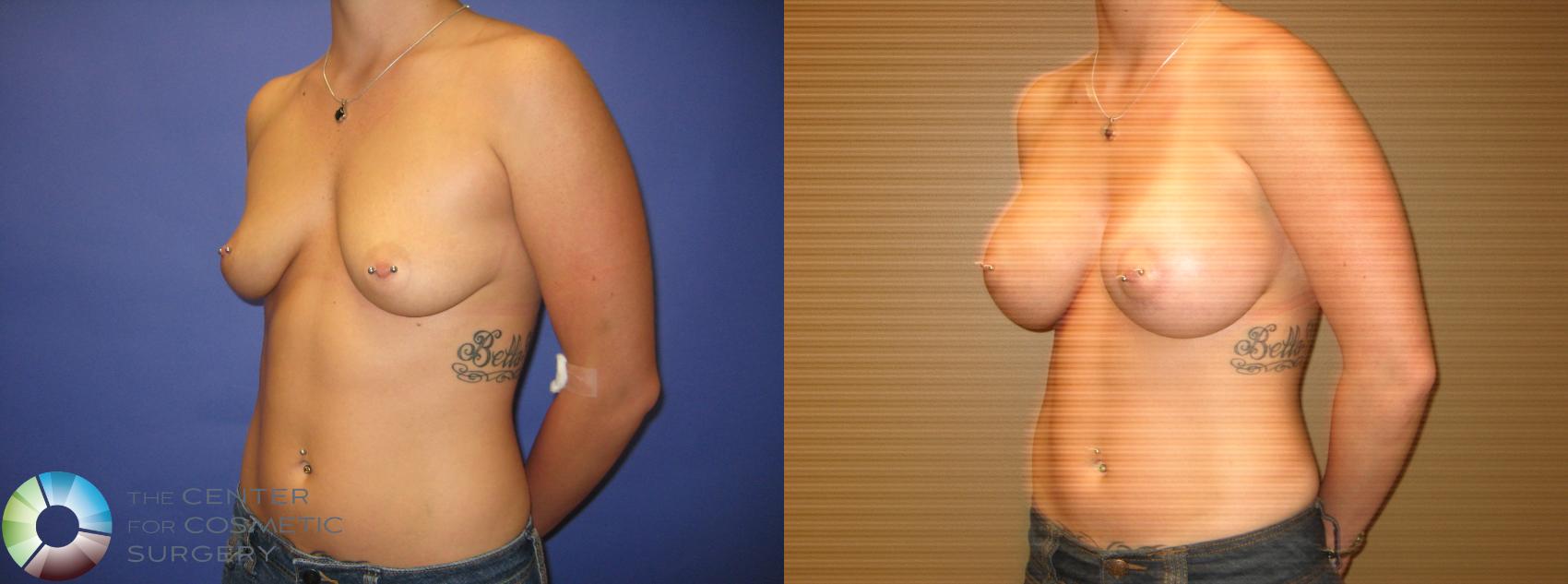 Before & After Breast Augmentation Case 294 View #2 View in Golden, CO