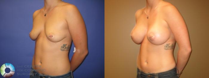 Before & After Breast Augmentation Case 294 View #2 View in Golden, CO