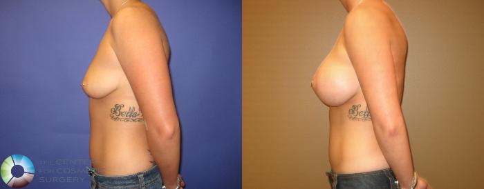 Before & After Breast Augmentation Case 294 View #3 View in Golden, CO