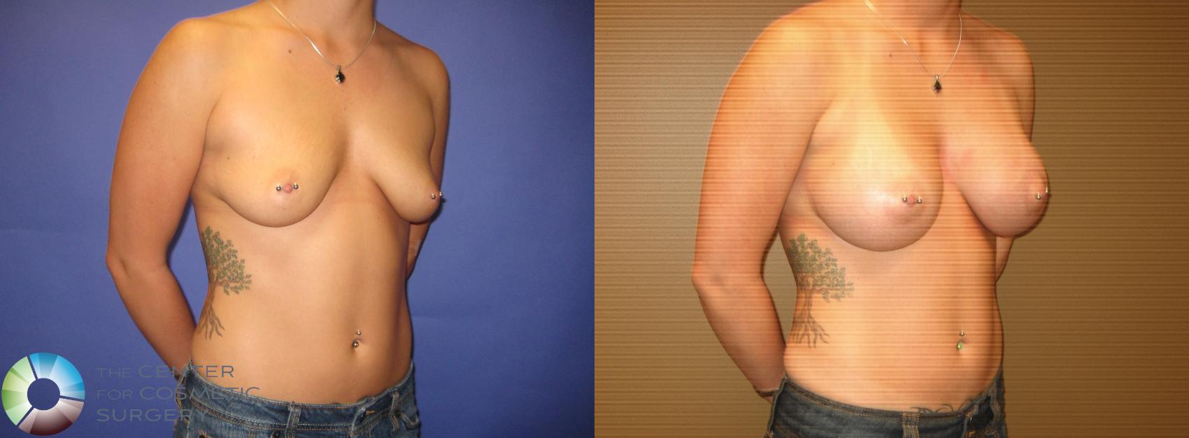 Before & After Breast Augmentation Case 294 View #4 View in Golden, CO