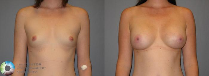 Before & After Breast Augmentation Case 300 View #1 View in Golden, CO
