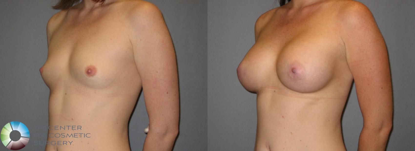 Before & After Breast Augmentation Case 300 View #2 in Denver and Colorado Springs, CO