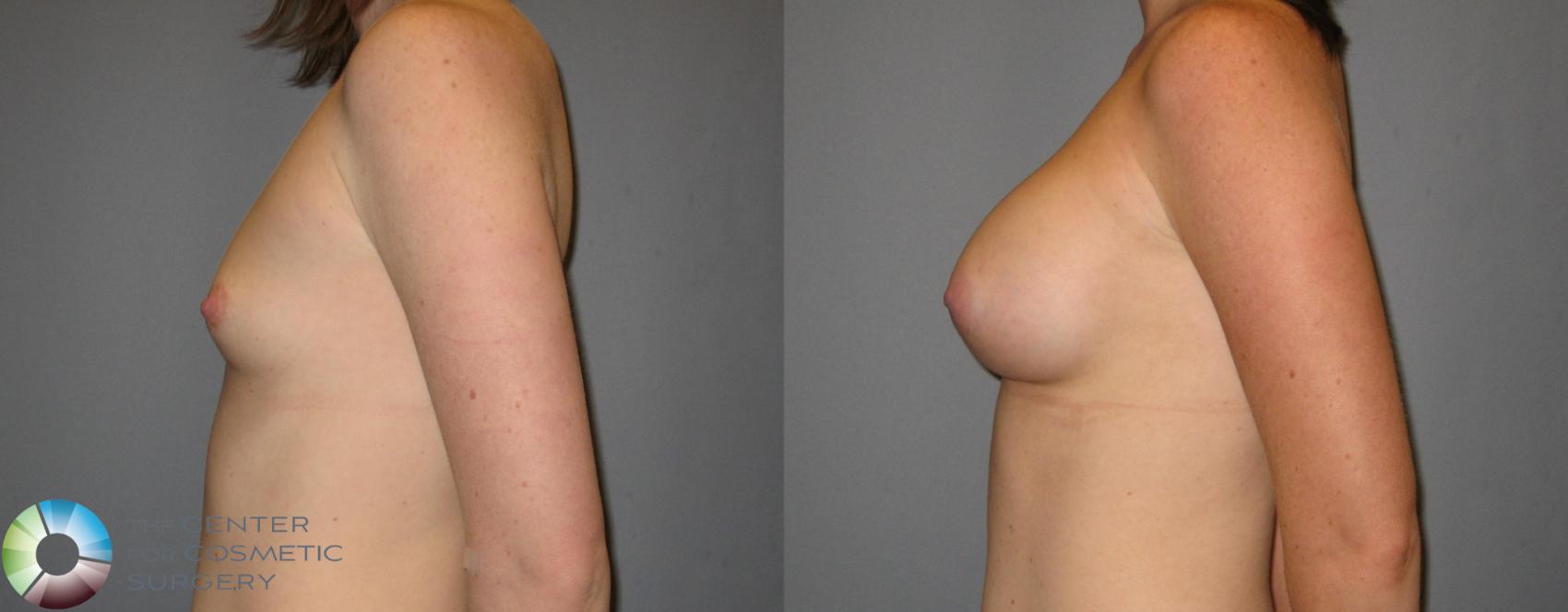 Before & After Breast Augmentation Case 300 View #3 in Denver and Colorado Springs, CO