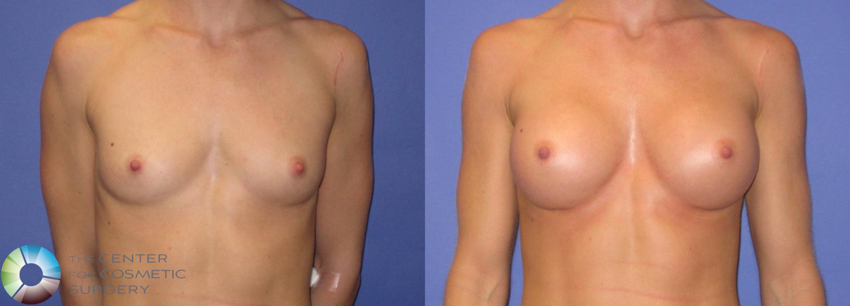 Before & After Breast Augmentation Case 307 View #1 in Denver and Colorado Springs, CO