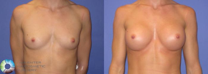 Before & After Breast Augmentation Case 307 View #1 View in Golden, CO