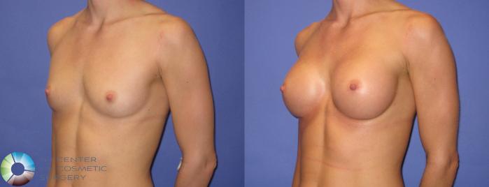 Before & After Breast Augmentation Case 307 View #2 View in Golden, CO