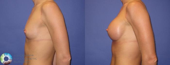 Before & After Breast Augmentation Case 307 View #3 View in Golden, CO