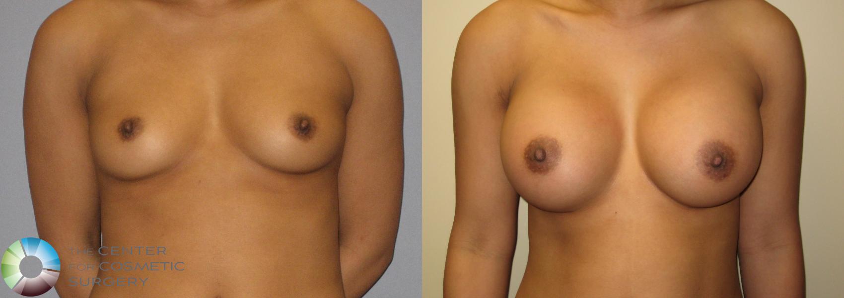 Before & After Breast Augmentation Case 309 View #1 in Denver and Colorado Springs, CO