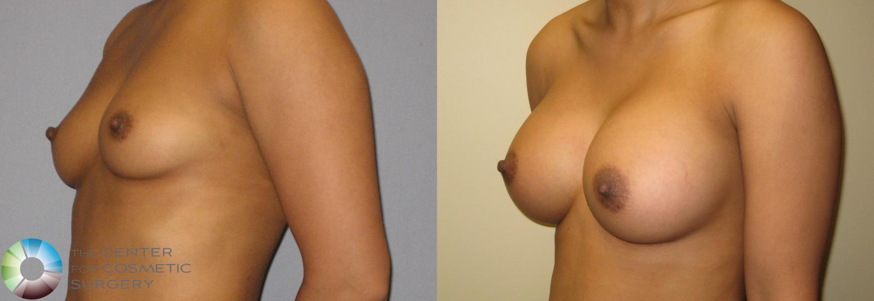 Before & After Breast Augmentation Case 309 View #2 View in Golden, CO