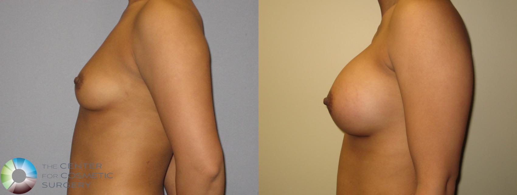 Before & After Breast Augmentation Case 309 View #3 View in Golden, CO