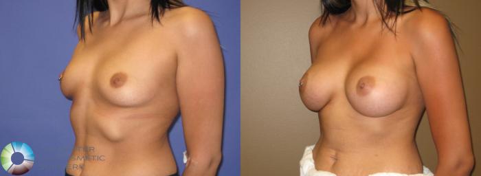 Before & After Breast Augmentation Case 311 View #1 in Denver and Colorado Springs, CO