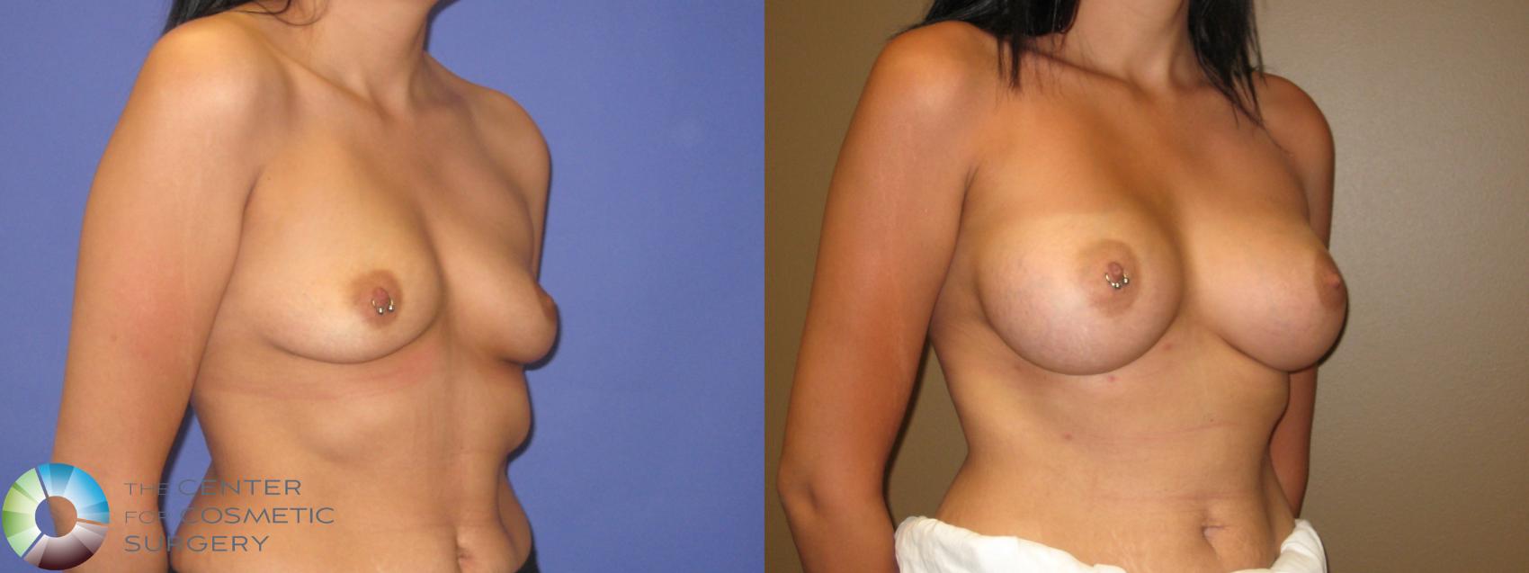 Before & After Breast Augmentation Case 311 View #2 in Denver and Colorado Springs, CO