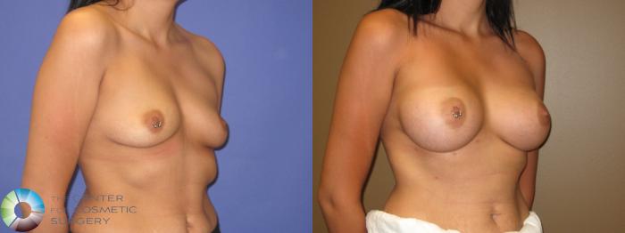 Before & After Breast Augmentation Case 311 View #2 in Denver and Colorado Springs, CO