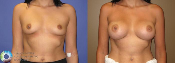 Before & After Breast Augmentation Case 311 View #3 in Denver and Colorado Springs, CO