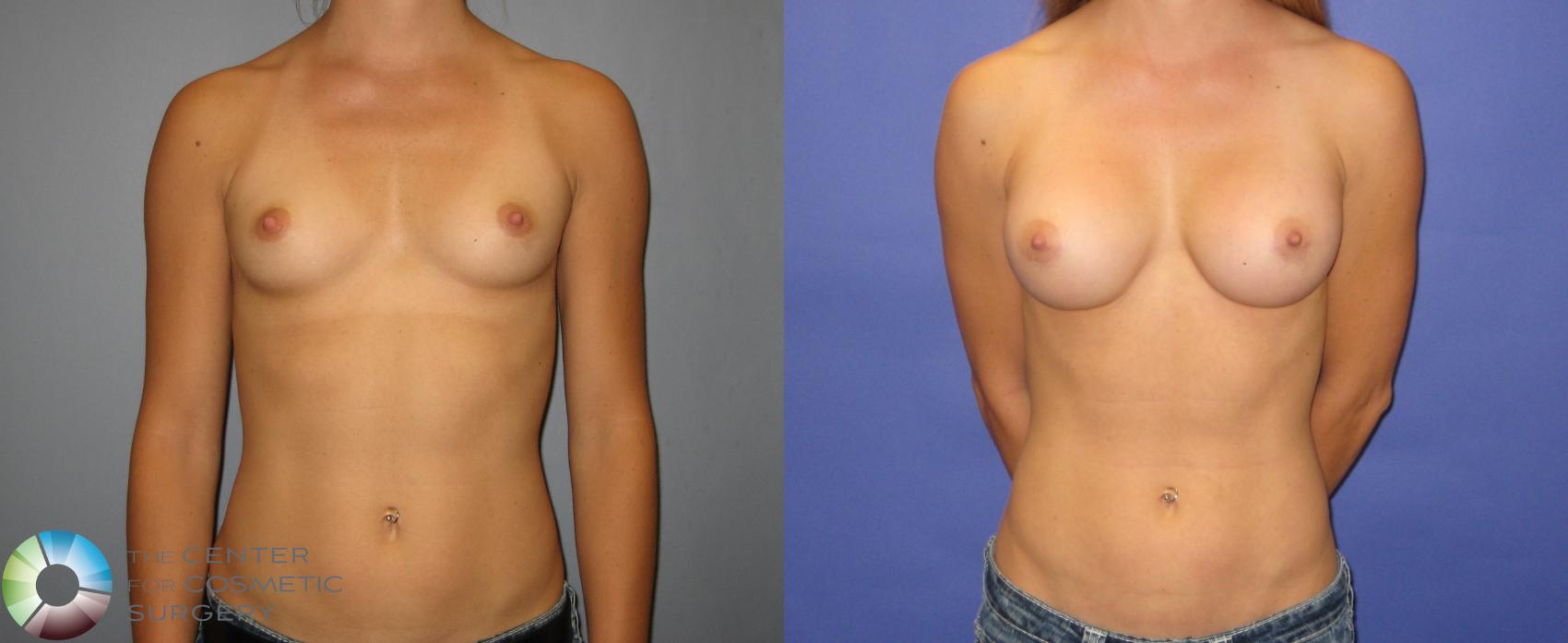 Before & After Breast Augmentation Case 315 View #1 in Denver and Colorado Springs, CO