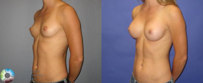 Before & After Breast Augmentation Case 315 View #2 in Denver and Colorado Springs, CO