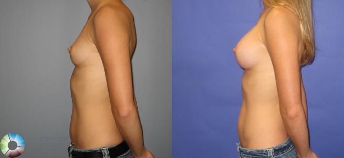 Before & After Breast Augmentation Case 315 View #3 in Denver and Colorado Springs, CO