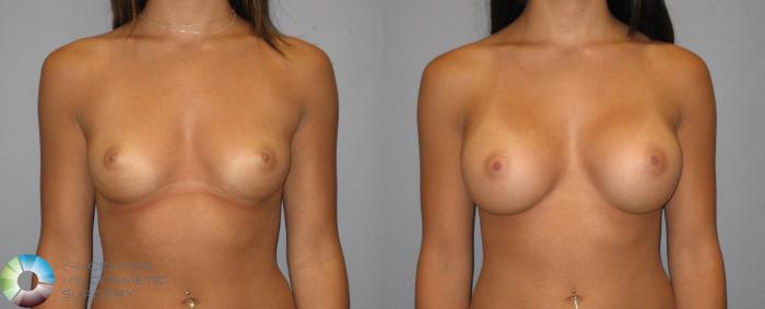 Before & After Breast Augmentation Case 318 View #1 in Denver and Colorado Springs, CO