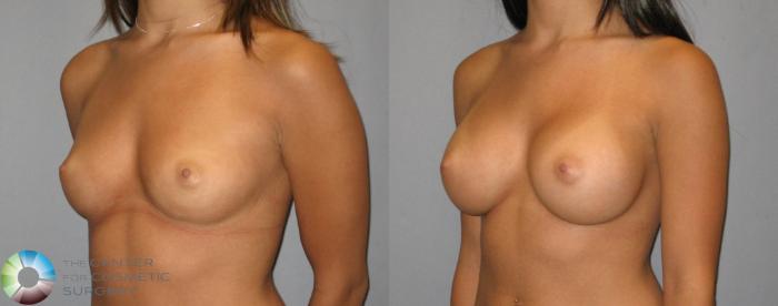 Before & After Breast Augmentation Case 318 View #2 in Denver and Colorado Springs, CO