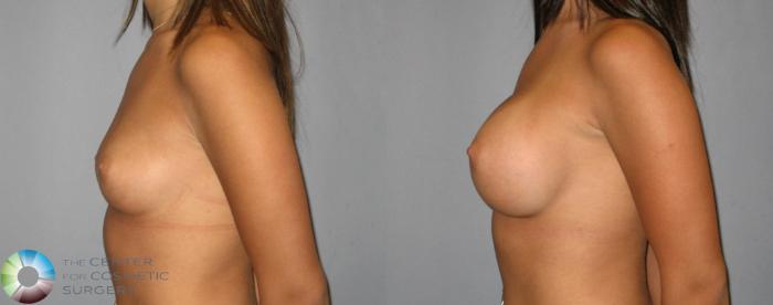 Before & After Breast Augmentation Case 318 View #3 in Denver and Colorado Springs, CO