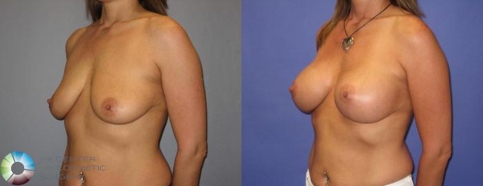 Before & After Breast Augmentation Case 319 View #1 in Denver, CO