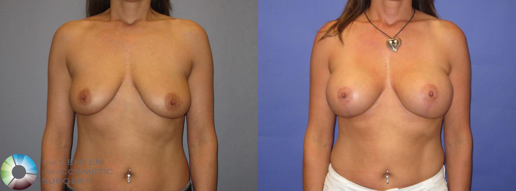 Before & After Breast Augmentation Case 319 View #2 in Denver and Colorado Springs, CO