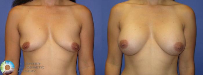 Before & After Breast Augmentation Case 322 View #1 View in Golden, CO