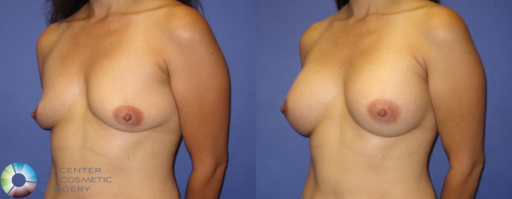 Before & After Breast Augmentation Case 322 View #2 in Denver and Colorado Springs, CO