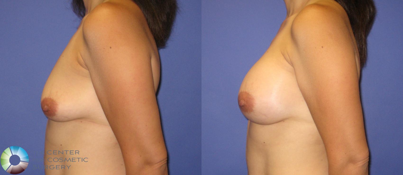 Before & After Breast Augmentation Case 322 View #3 in Denver and Colorado Springs, CO